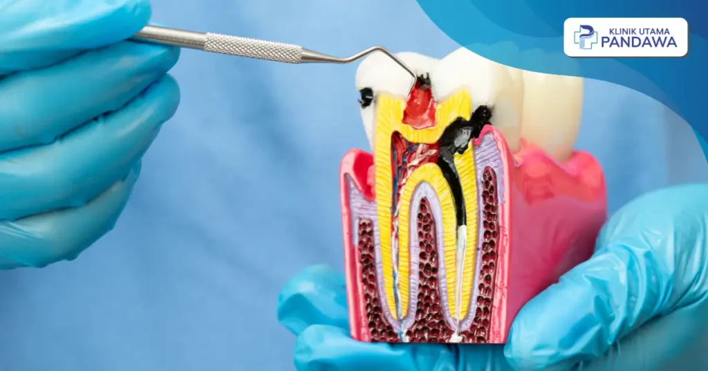 infeksi saluran akar gigi