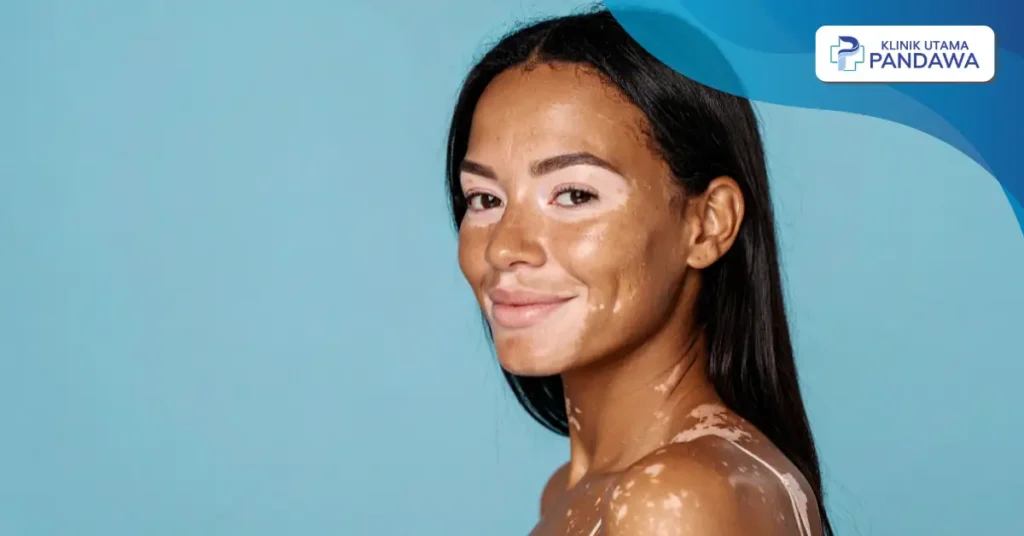 vitiligo bisa sembuh