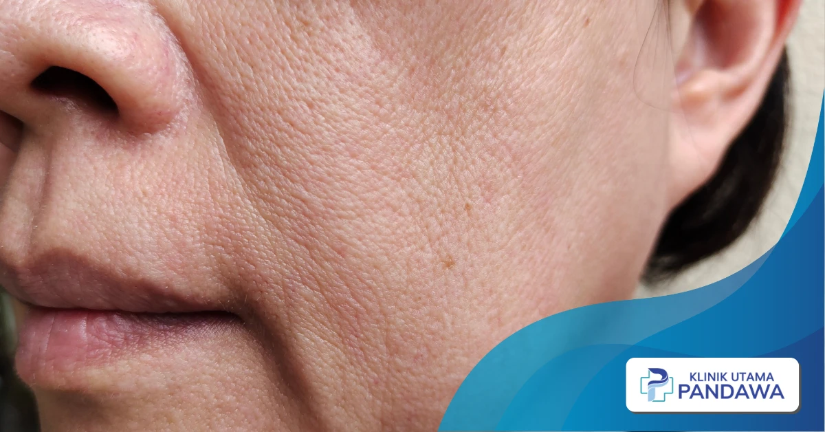 Cara Mengurangi Smile Line agar Wajah Tetap Awet Muda