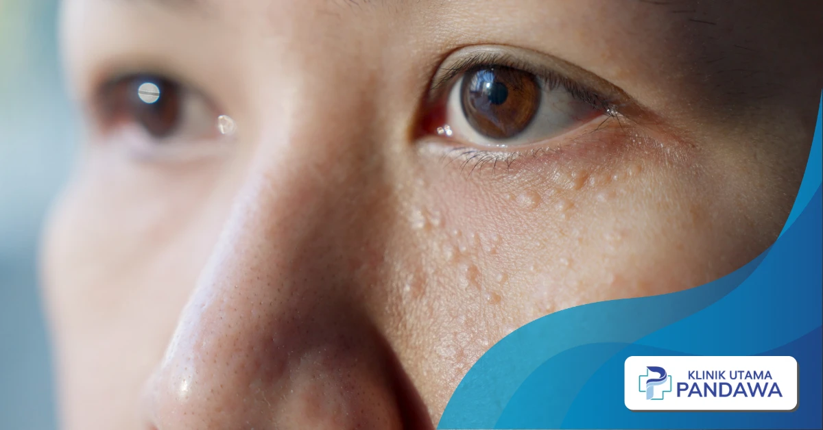 Cara Menghilangkan Milia di Wajah Secara Alami