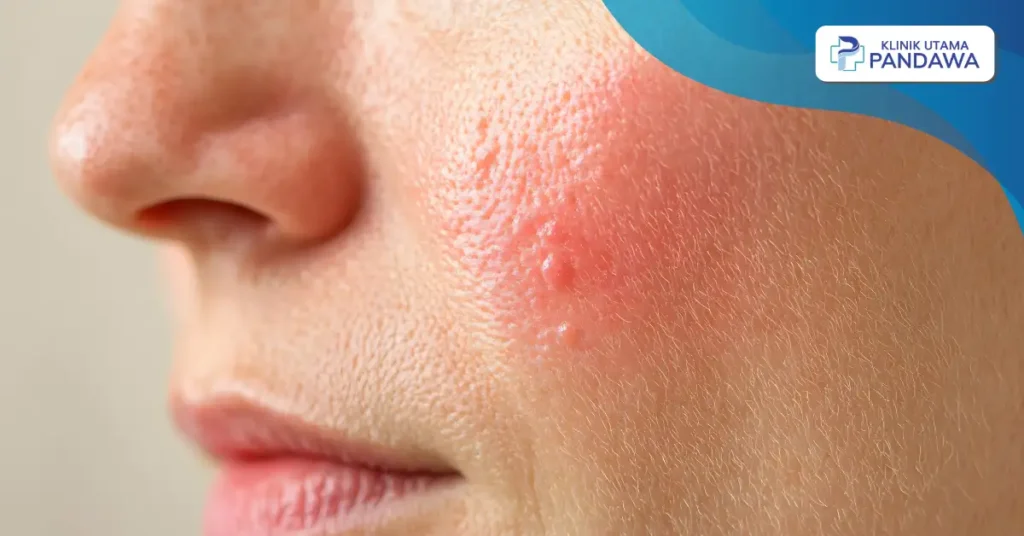 ciri-ciri muka iritasi karena skincare