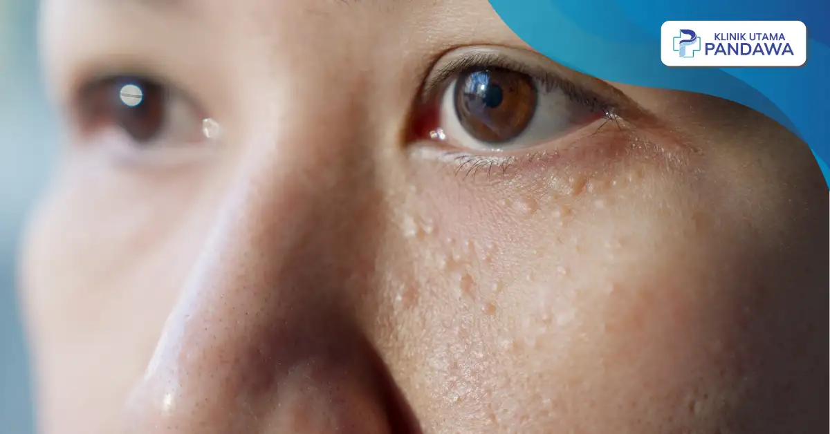 Cara Menghilangkan Milia dengan Aman dan Efektif