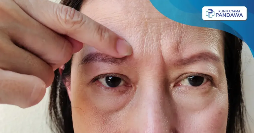 perbedaan lentigo dan melasma