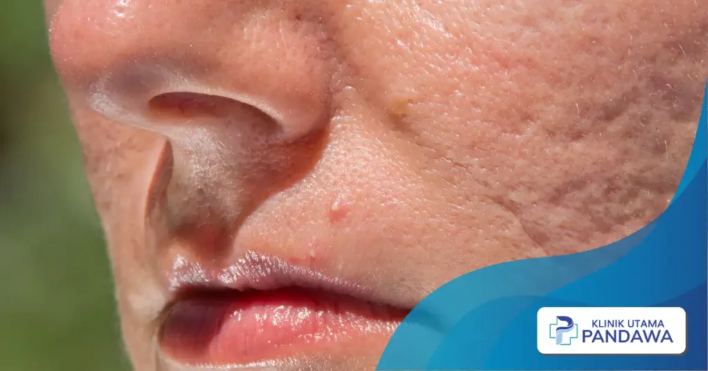 ice pick scars