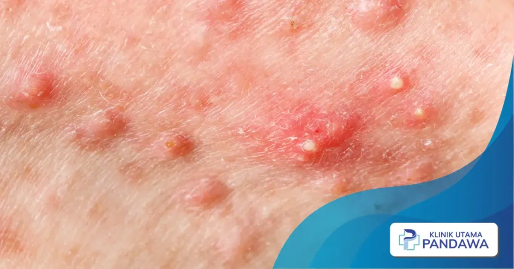 acne prone skin adalah