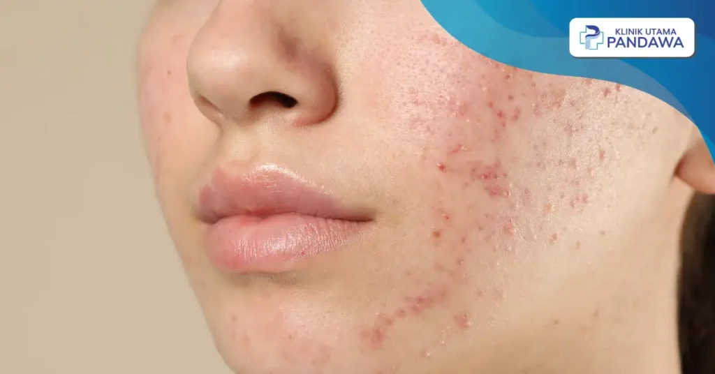 acne prone skin adalah