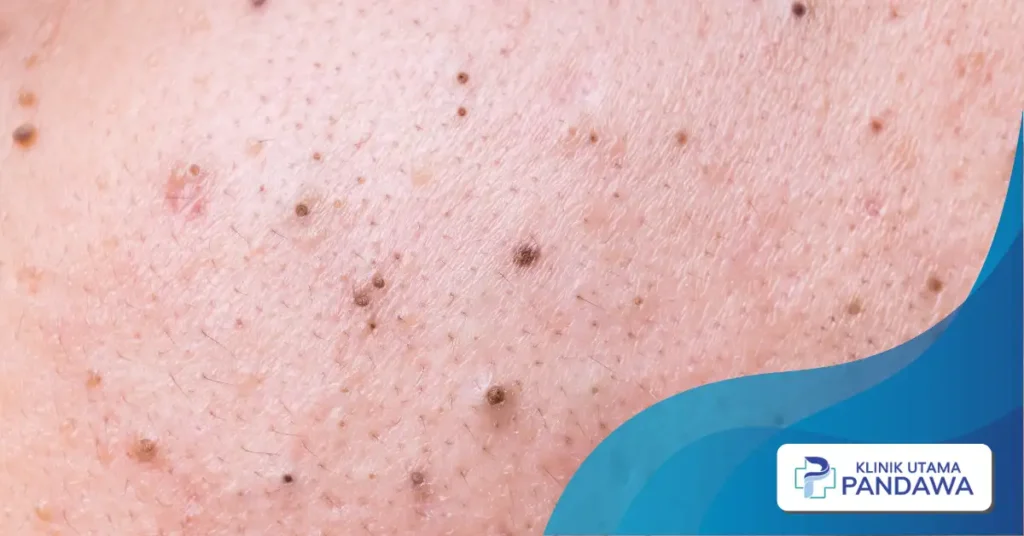 blackhead