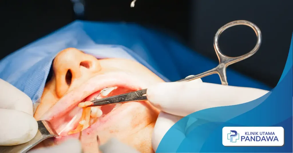 buccal fat removal