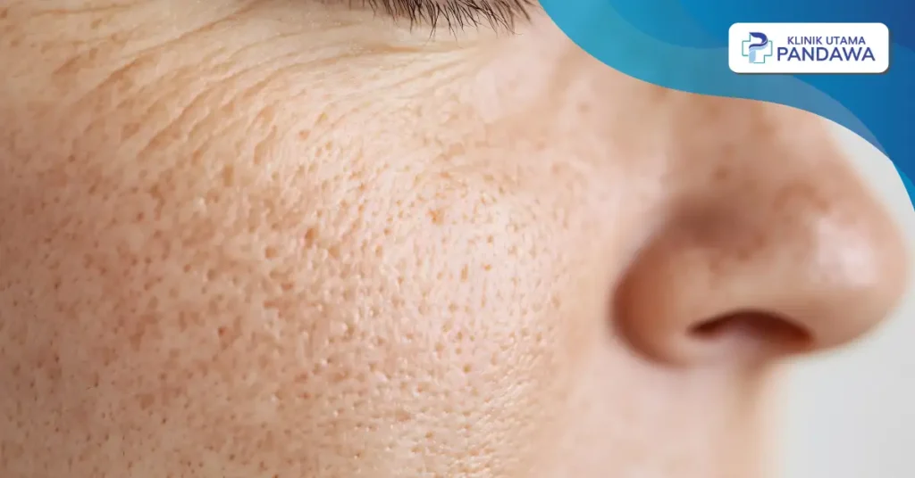 cara menghilangkan chicken skin