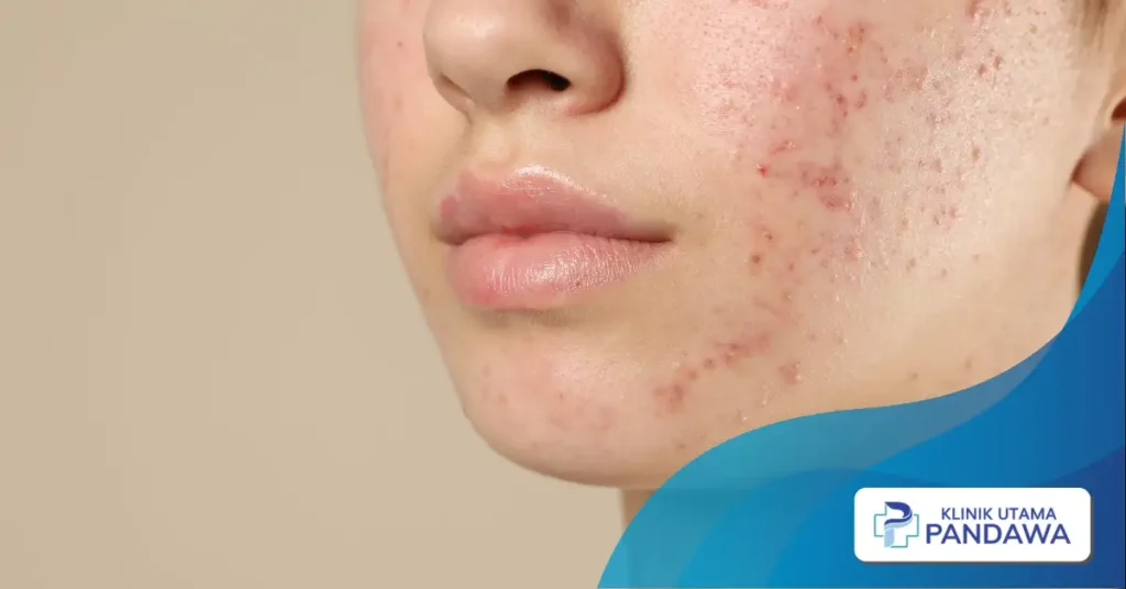 fungal acne