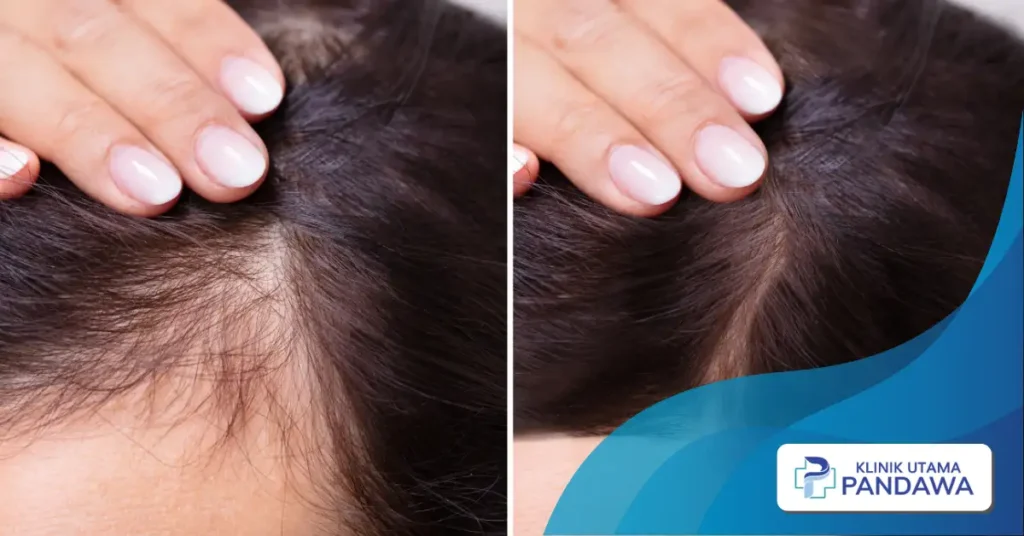 hair loss treatment