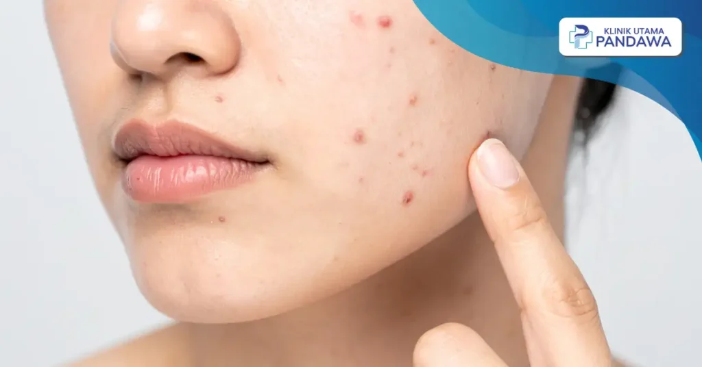 jerawat mendem