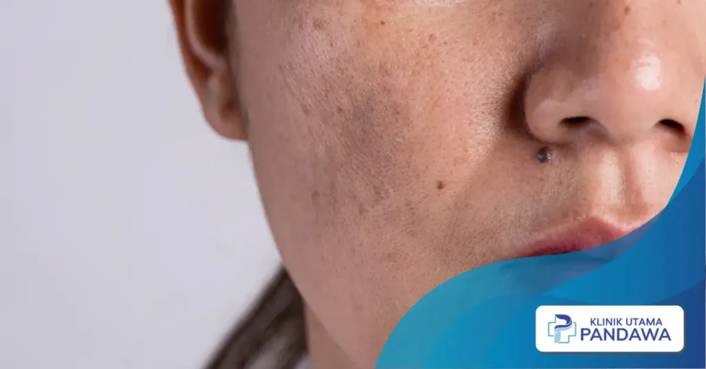 melasma