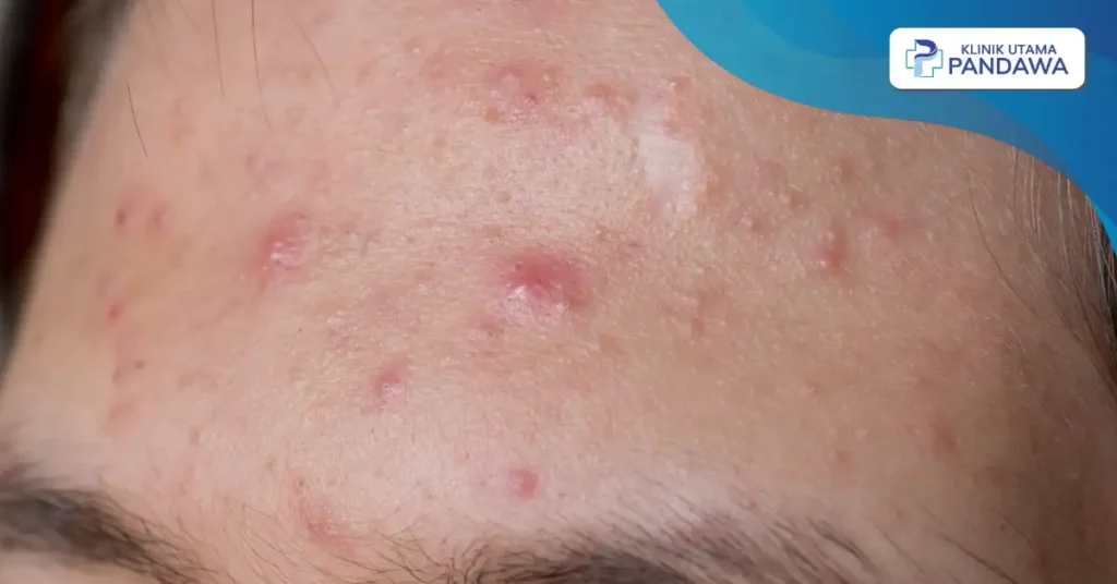 penyebab jerawat di jidat