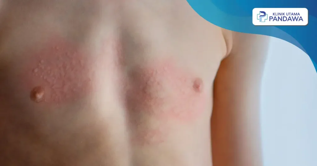 bintik merah pada kulit tidak gatal