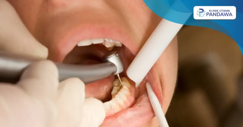 cara menghilangkan sakit gigi berlubang agar tidak kambuh lagi