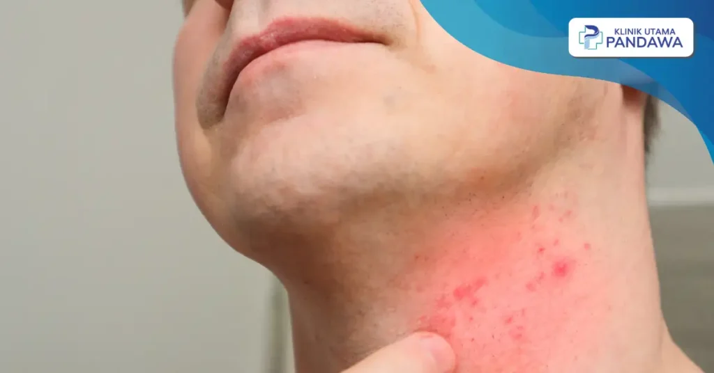 jerawat di leher