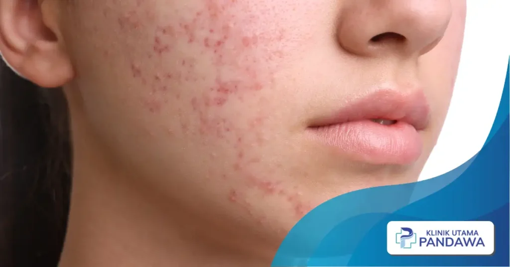 keloid bekas jerawat