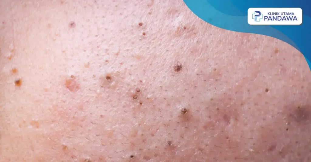 komedo hitam di pipi