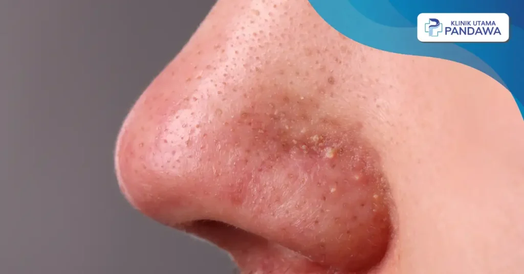 penyebab jerawat di hidung