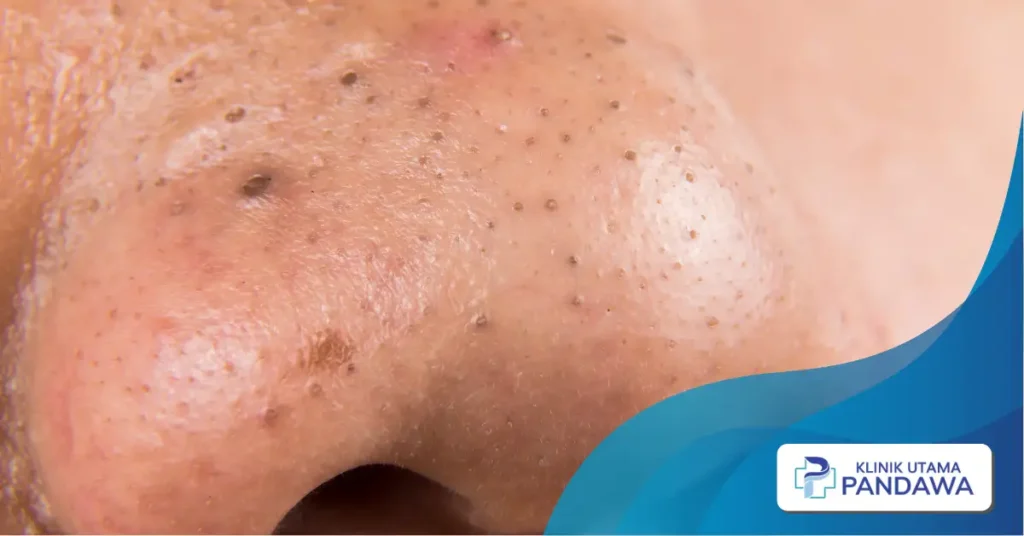 penyebab jerawat di hidung