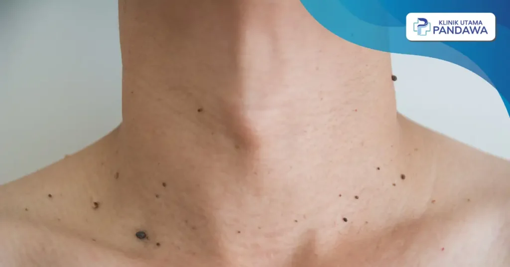 penyebab kutil di leher