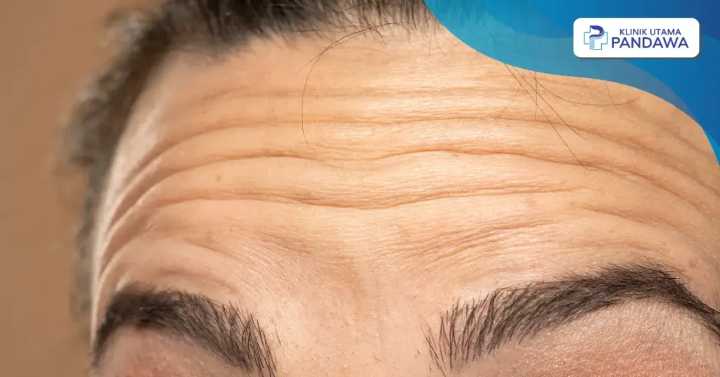 cara menghilangkan kerutan di dahi