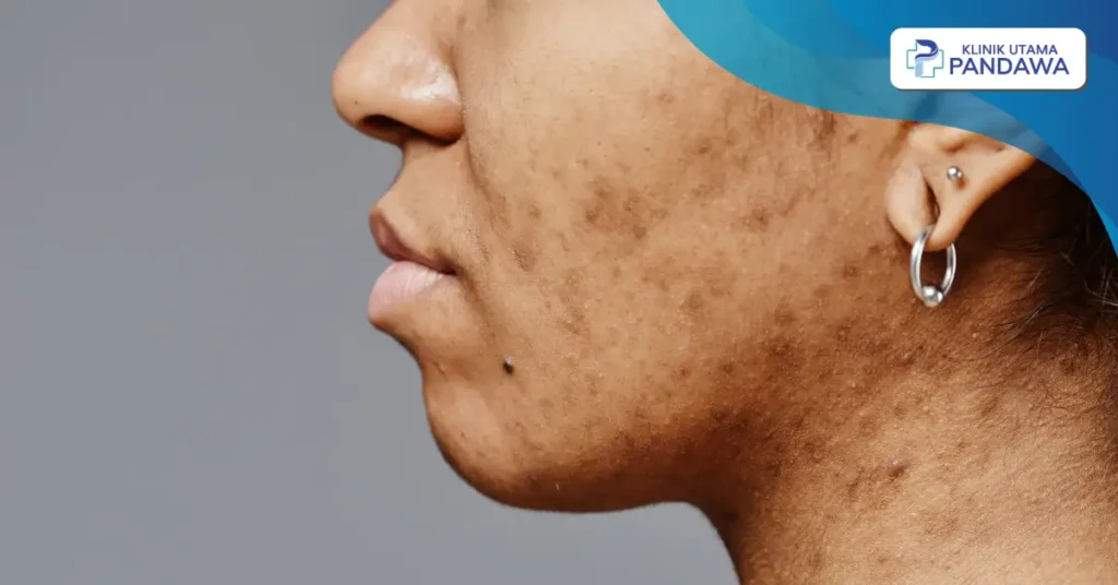 jenis flek hitam di wajah