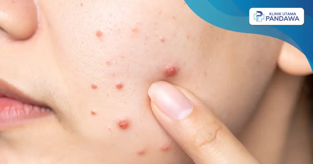 penyebab jerawat di pipi