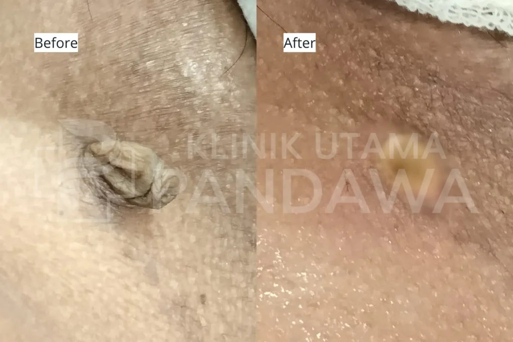 before after nevus removal 1