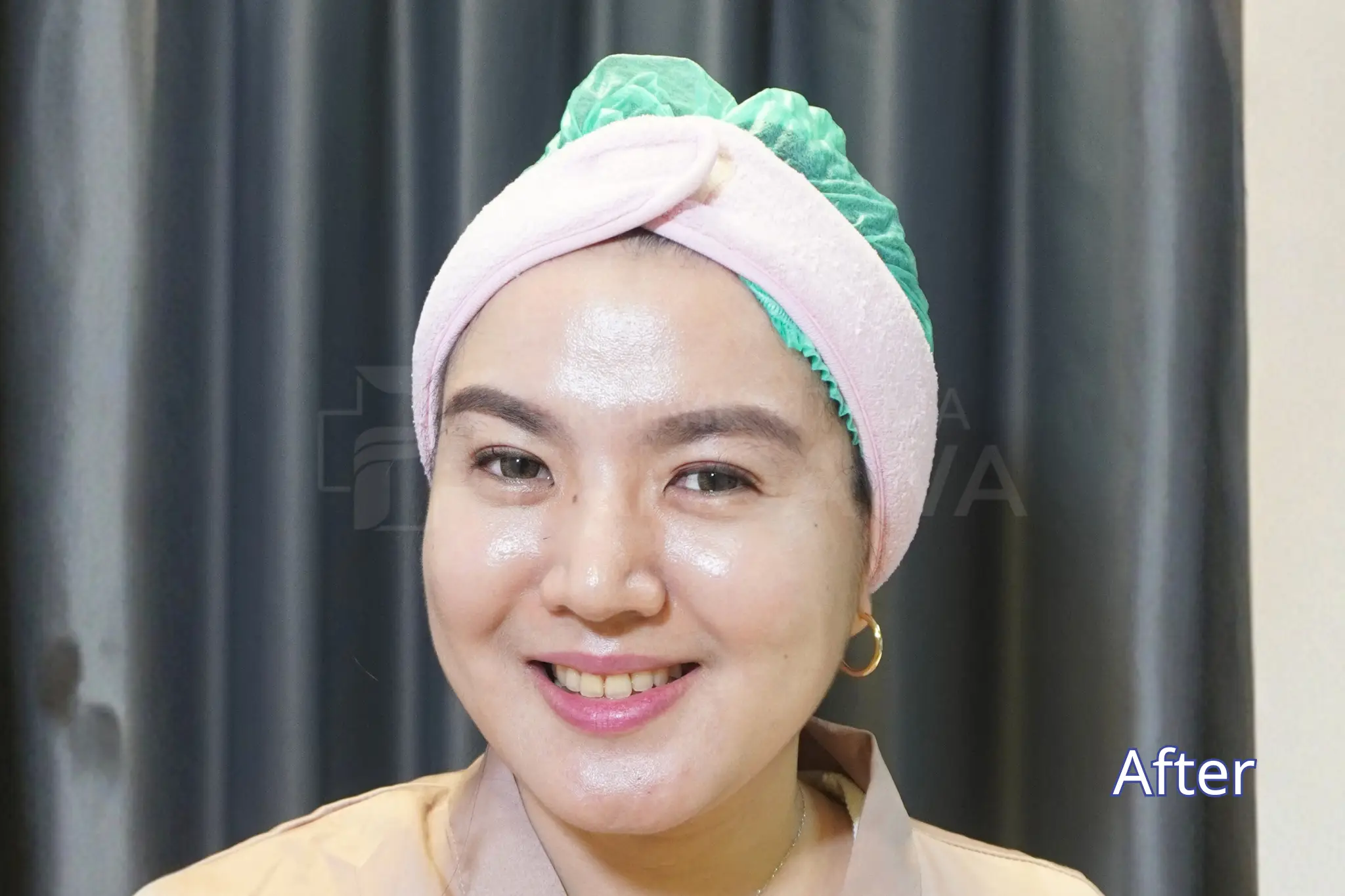 before dermalinfusion facial