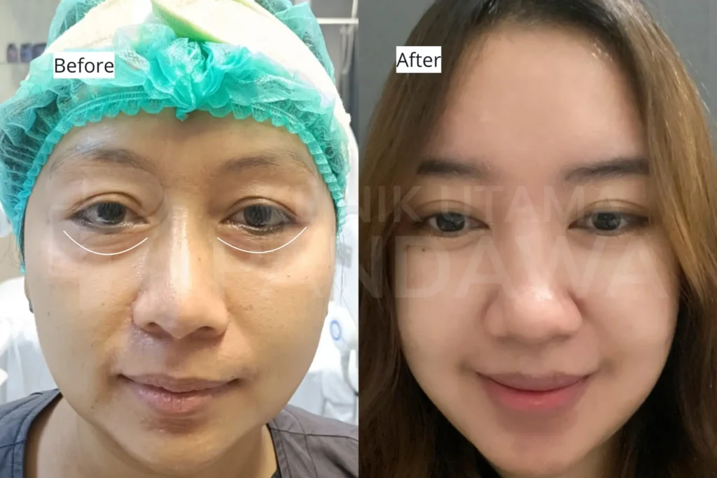 blepharoplasty eyebag removal