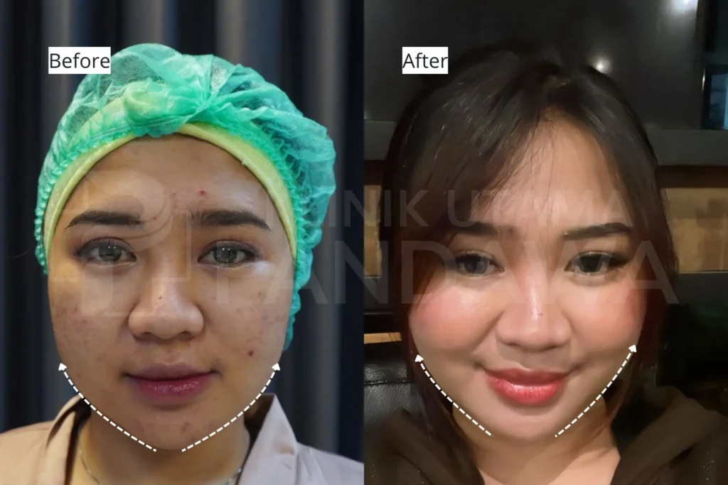 buccal fat removal - before after 1