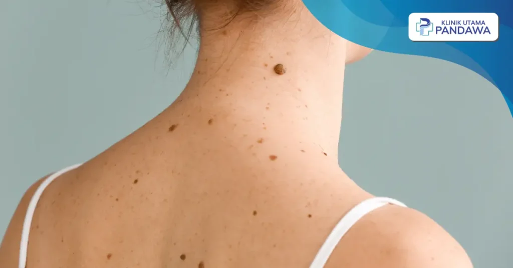 cara menghilangkan tompel