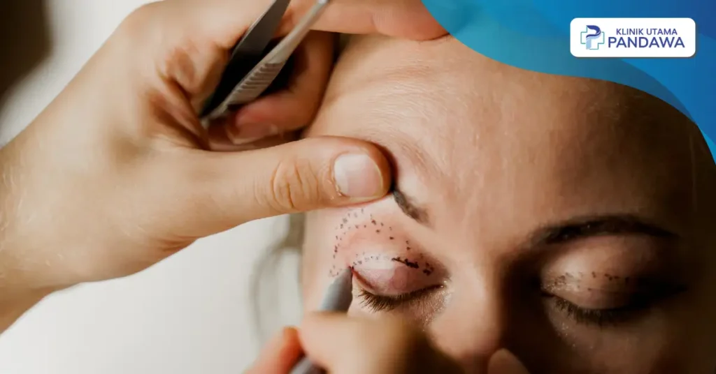 operasi lipatan mata