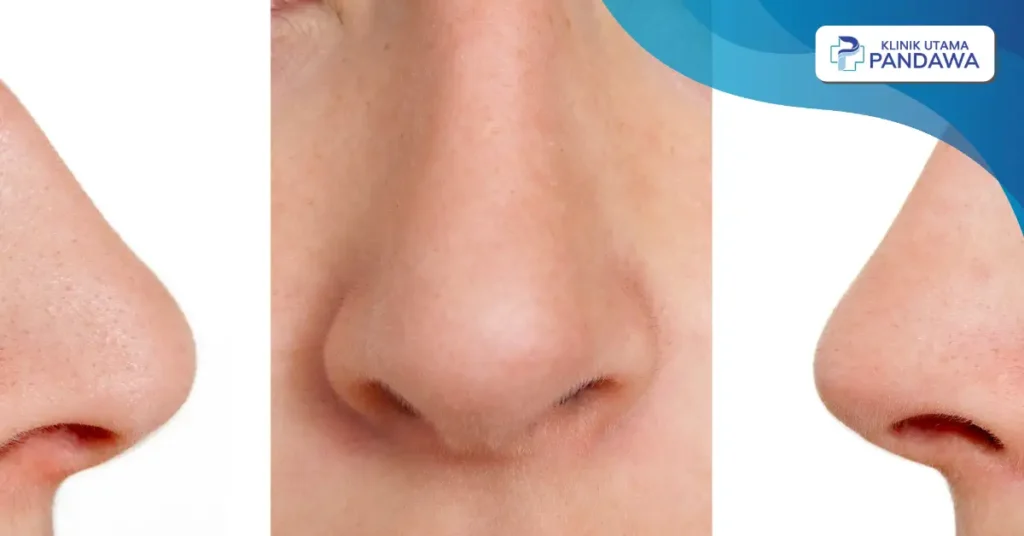 perbedaan hidung mancung dan pesek