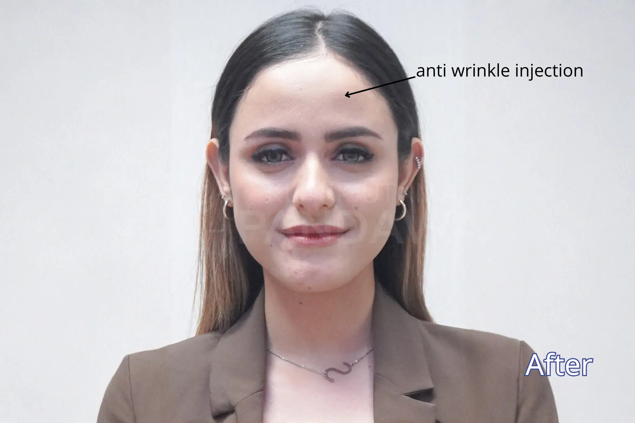 testi btox anti wrinkle - pandawa