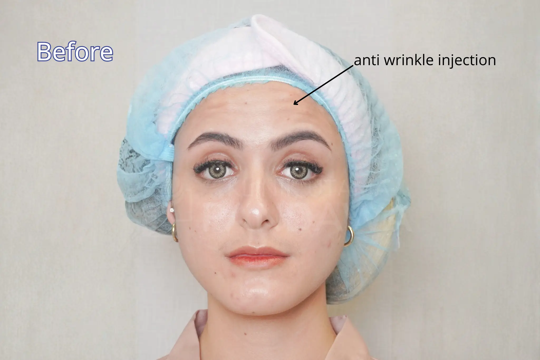 testi btox anti wrinkles - pandawa