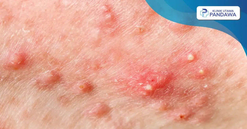 jerawat nodul