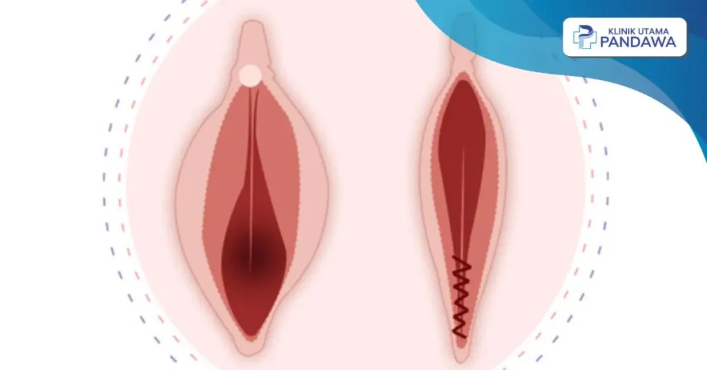 biaya operasi perineoplasty