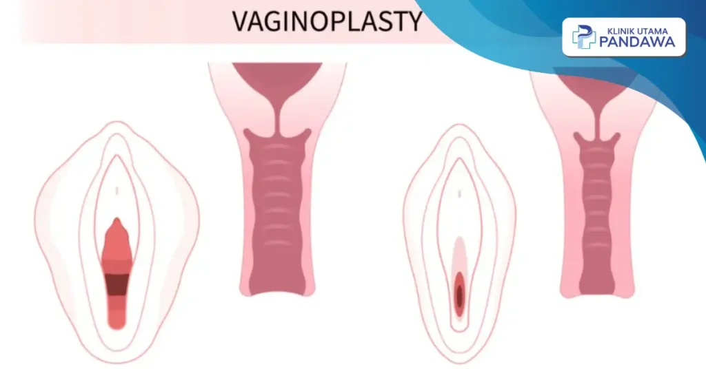 biaya vaginoplasty