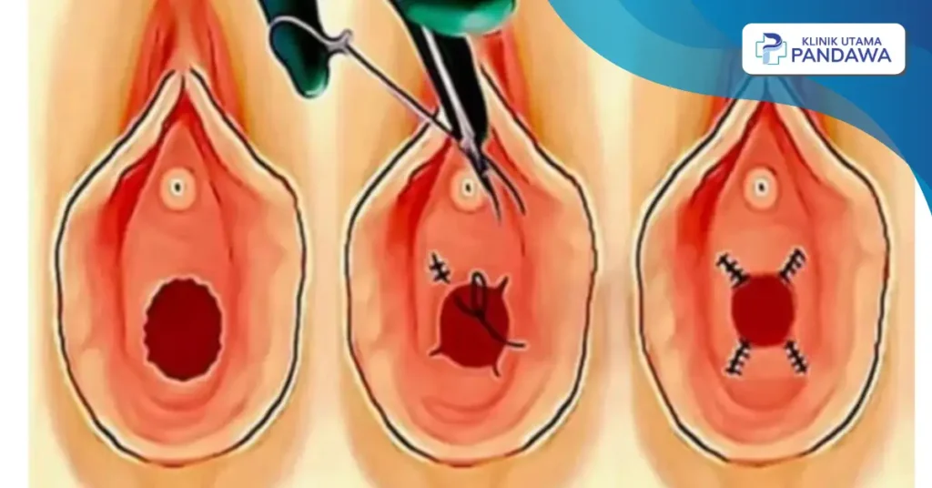 harga operasi hymenoplasty