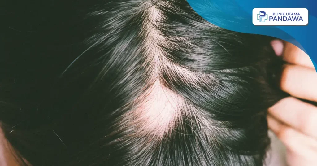 Alopecia areata