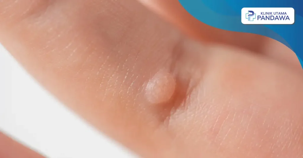 Pengobatan Verruca Vulgaris