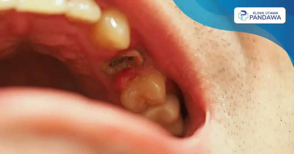 biaya cabut sisa akar gigi