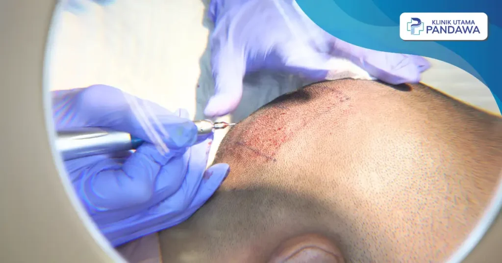 biaya hair transplant