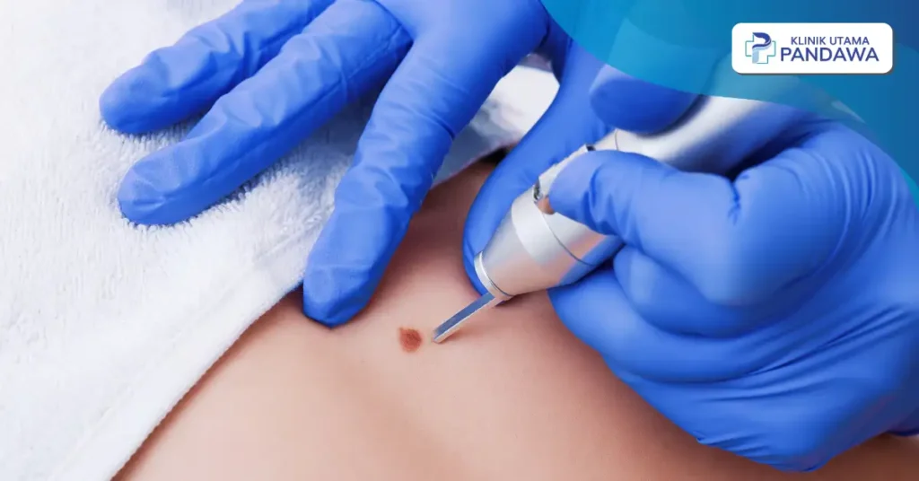 harga skin tag removal