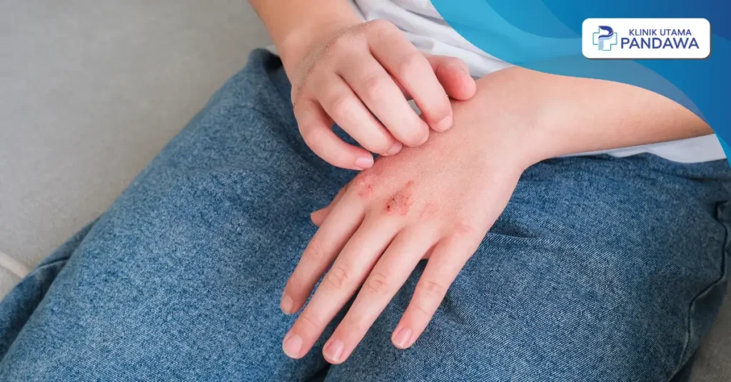 penyebab iktiosis vulgaris