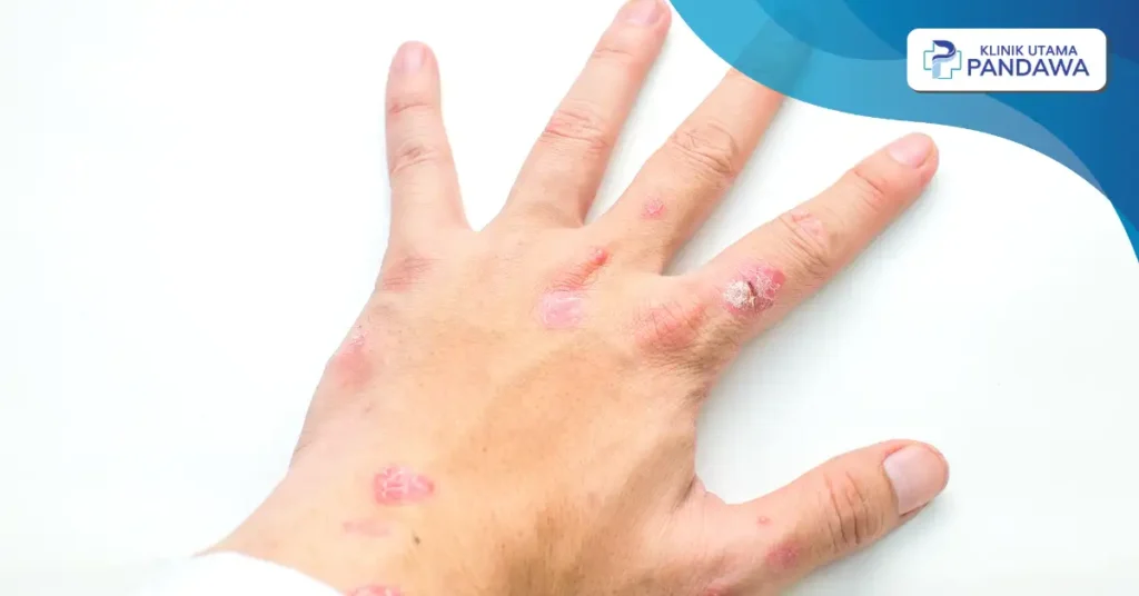 psoriasis vulgaris adalah