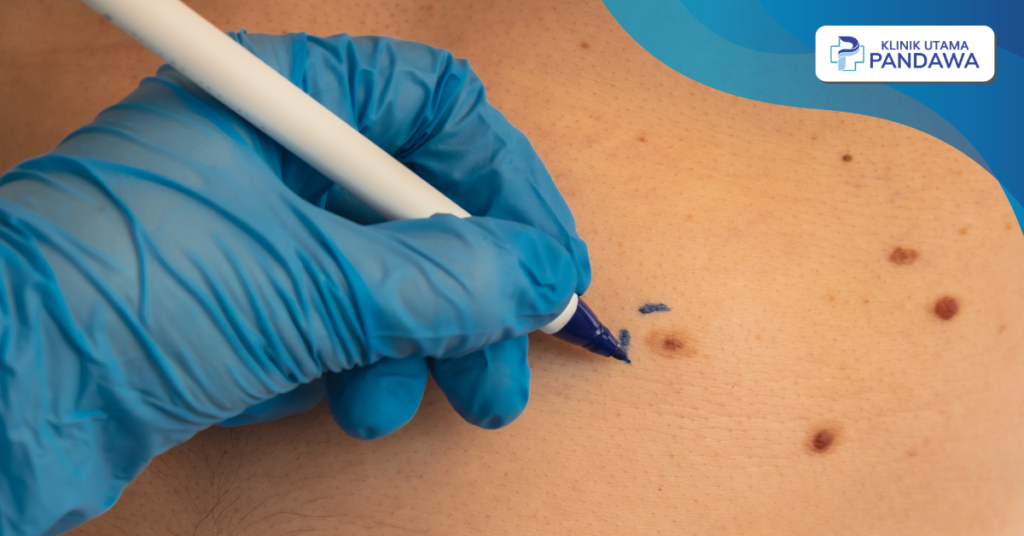 Cara Menghilangkan tanda lahir